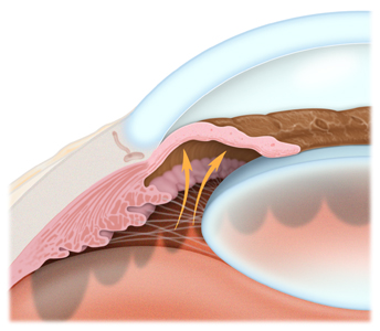 Glaucoma—The Basics - West Coast Glaucoma : West Coast Glaucoma