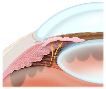 Peripheral Iridotomy West Coast Glaucoma West Coast Glaucoma