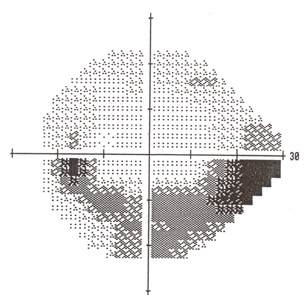 glaucoma vision loss pattern