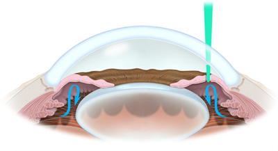 Peripheral Iridotomy West Coast Glaucoma West Coast Glaucoma